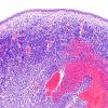 5B1 Hemorrhage, neonatal (Case 5) H&E 2