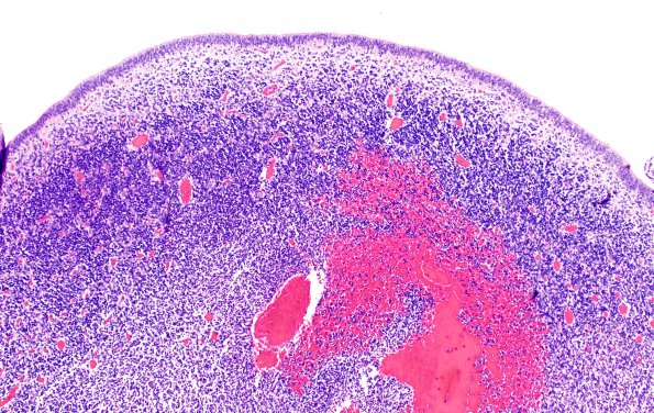 5B1 Hemorrhage, neonatal (Case 5) H&E 2