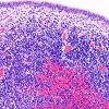 5B2 Hemorrhage, neonatal (Case 5) H&E 1