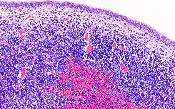 5B2 Hemorrhage, neonatal (Case 5) H&E 1