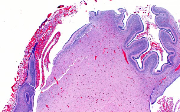 5C1 Fetal vascularization (Case 5) H&E 2X