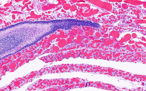 5C2 Fetal vascularization (Case 5) H&E 10X