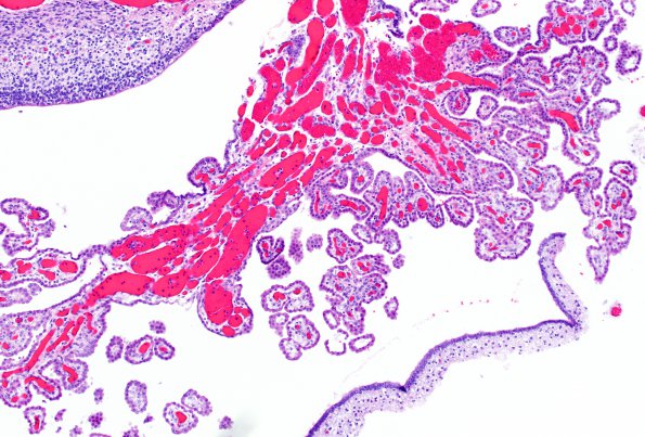 5C3 Fetal vascularization (Case 5) H&E 2X A