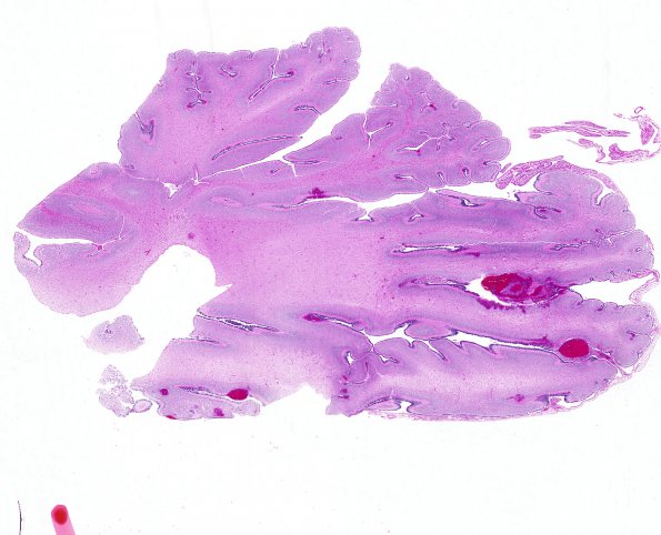 6A1 Hypoxia Ischemia, neonatal, Subpial H Cbell (Case 6)