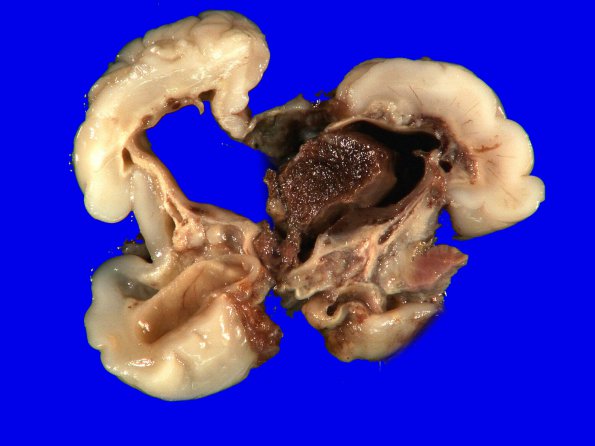 7A1 Hypoxia-Ischemia (IVH, PVL, Malformation, Case 7) 8