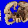 7A2 Hypoxia-Ischemia (IVH, PVL, Malformation, Case 7) 9