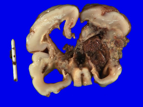 7A2 Hypoxia-Ischemia (IVH, PVL, Malformation, Case 7) 9