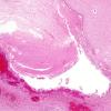 7B1 Hypoxia-Ischemia (IVH, PVL, Malformation, Case 7) H&E 1