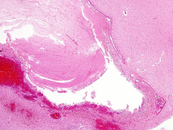 7B1 Hypoxia-Ischemia (IVH, PVL, Malformation, Case 7) H&E 1