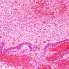 7B2 Hypoxia-Ischemia (IVH, PVL, Malformation, Case 7) H&E 4