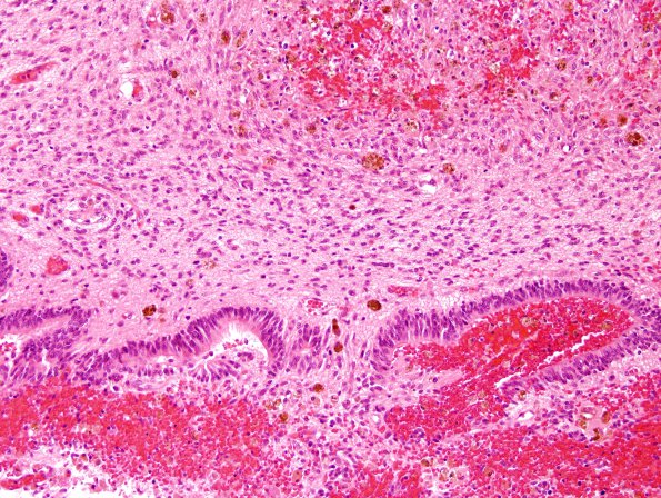 7B2 Hypoxia-Ischemia (IVH, PVL, Malformation, Case 7) H&E 4