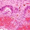 7B3 Hypoxia-Ischemia (IVH, PVL, Malformation, Case 7) H&E 5