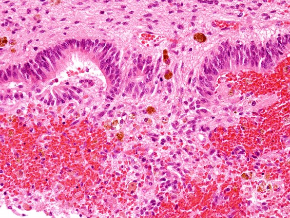 7B3 Hypoxia-Ischemia (IVH, PVL, Malformation, Case 7) H&E 5