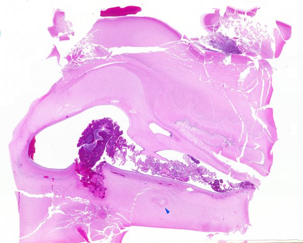 8A1 Hemorrhage, neonatal, choroid plexus (Case 8) H&E WM2 copy