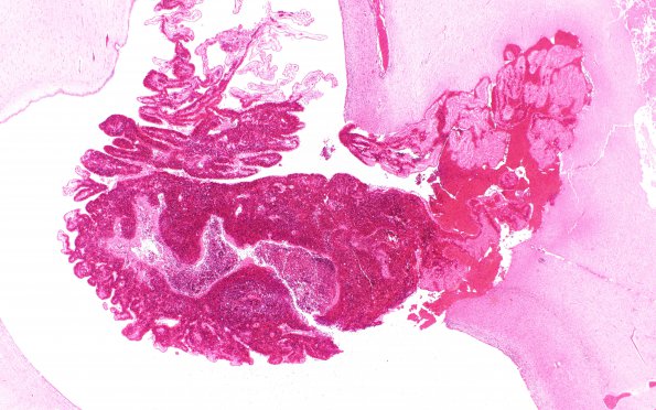 8A2 Hemorrhage, neonatal, choroid plexus (Case 8) N18 H&E 2X 2