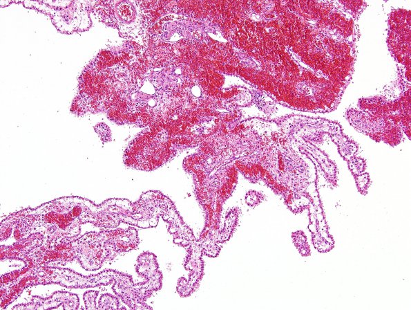 8A3 Hemorrhage, neonatal, choroid plexus (Case 8) H&E 2