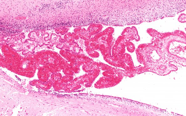 8A4 Hemorrhage, neonatal, choroid plexus (Case 8) N18 H&E 10X