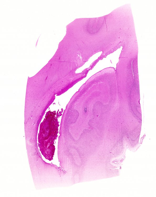 9A1 Hemorrhage, neonatal, intraventricular (Case 9, Choroid Plexus Source) H&E