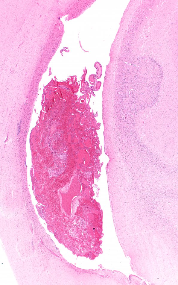 9A2 Hemorrhage, IVH choroid plexus (Case 9) H&E 2X