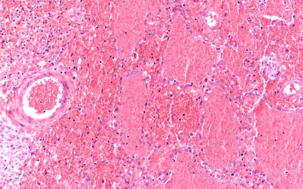 9A3 Hemorrhage, IVH choroid plexus (Case 9) H&E 20X