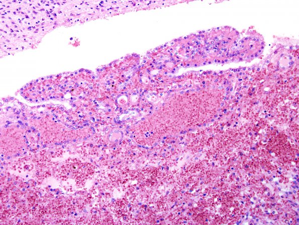 9A3 Hemorrhage, neonatal, intraventricular (Case 9, Choroid Plexus Source) H&E 2