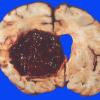 1 Hemorrhage, HT (Case 1)