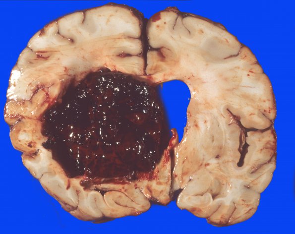 1 Hemorrhage, HT (Case 1)