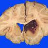 10 Hemorrhage, hypertensive (Case 10)