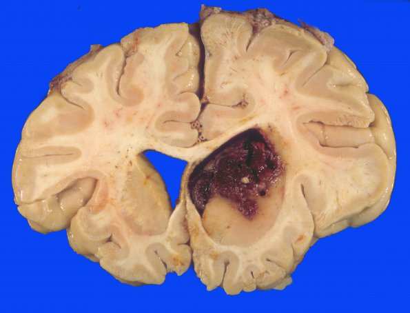 10 Hemorrhage, hypertensive (Case 10)