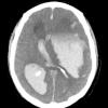 11 Hemorrhage, hypertensive (Case 11) CT - Copy