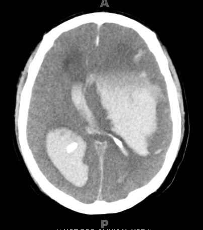 11 Hemorrhage, hypertensive (Case 11) CT - Copy