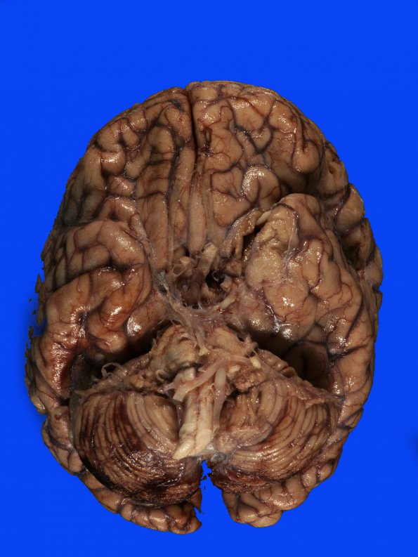 11A`Hemorrhage, hypertensive & uncal & cingulate herniation (Case 11) 1