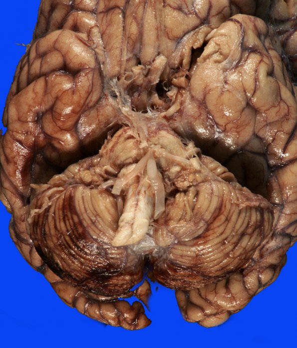 11B Hemorrhage, hypertensive & uncal & cingulate herniation (ACase 11) 2