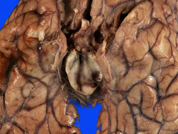 11C Hemorrhage, hypertensive & uncal & cingulate herniation (Case 11) 4