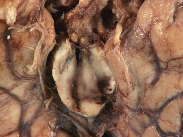 11D Hemorrhage, hypertensive & uncal & cingulate herniation (Case 11) 3