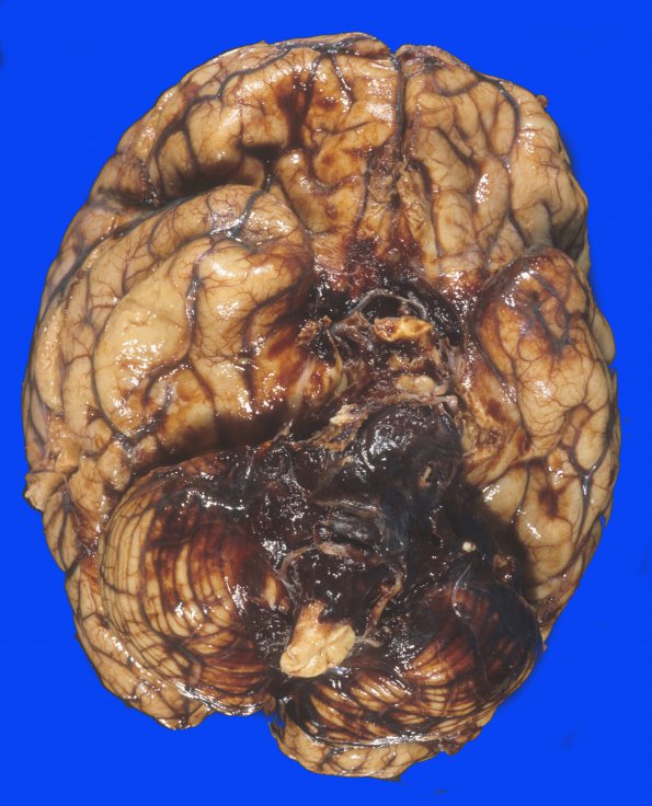 12 Hemorrhage, hypertensive, basal ganglia (Case 12) 1