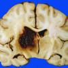 13A Hemorrhage, HT (Case 13) 30 day survival