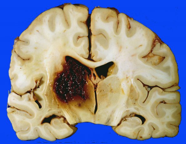 13A Hemorrhage, HT (Case 13) 30 day survival