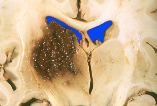 13B Hemorrhage, HT, thalamus (Case 14) gross 1