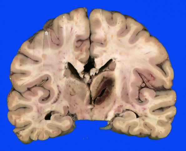 14 Hemorrhage, hypertensive correlate with CT 1 mo (Case 14) _