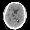 14A Hemorrhage, hypertensive, resolving (Case 14) CT 1mo after bleed - Copy