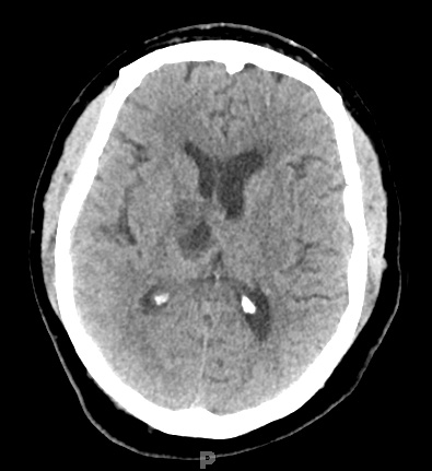 14A Hemorrhage, hypertensive, resolving (Case 14) CT 1mo after bleed - Copy