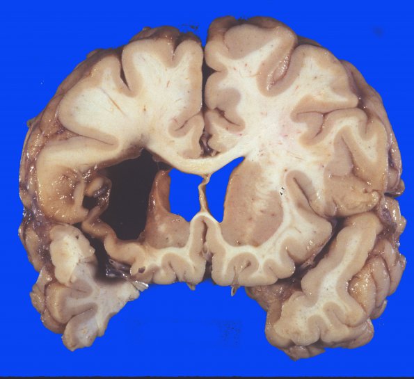 15 Hemorrhage, probable hypertensive, long survival (Case 15) gross 1