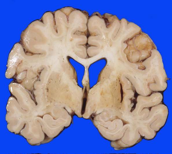 16 Hemorrhage, remote, hypertension (Case 16) 1