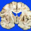 17A Hemorrhage, HT Old (Case 17) striatal 2