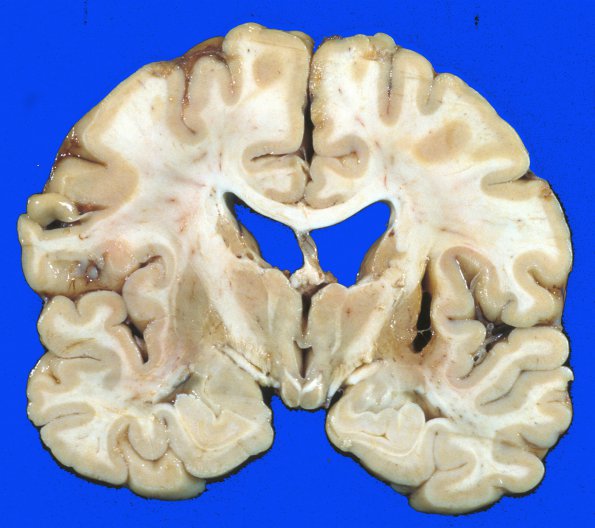 17A Hemorrhage, HT Old (Case 17) striatal 2