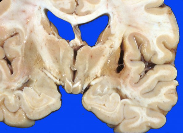 17B Hemorrhage, HT Old (Case 17) striatal 1