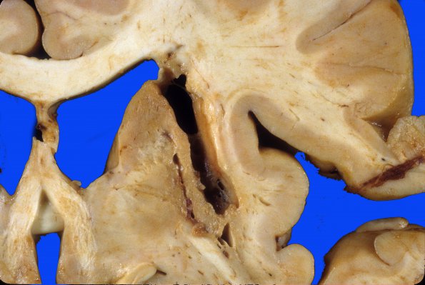 18B Hemorrhage, remote, hypertensive (Case 18) 1