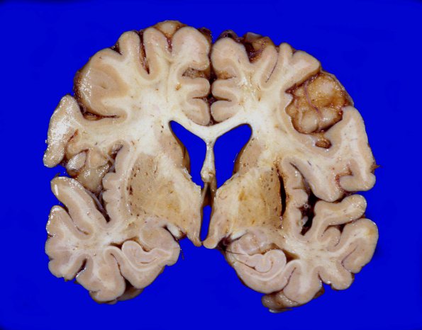 19 Hemorrhage, HT Residua (Case 19) gross 1