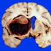 2 Hemorrhage, HT (Case 2) gross 1